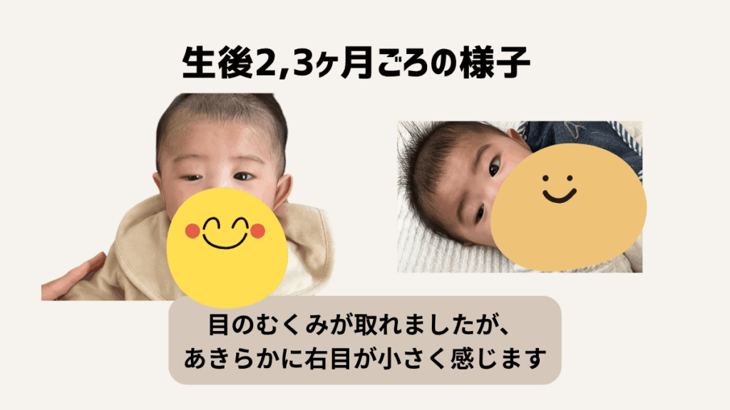 赤ちゃんの先天性眼瞼下垂と診断された話|生後2,3ヶ月ごろの様子